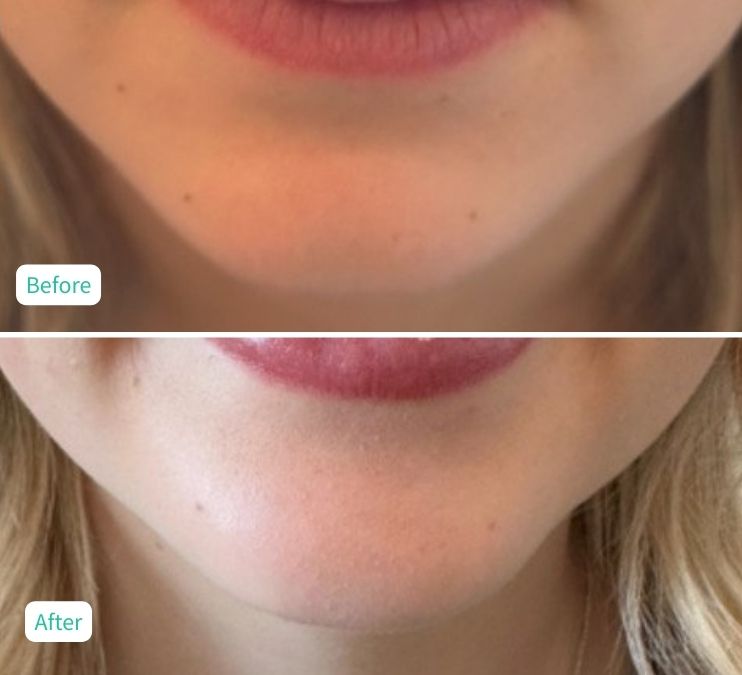 Chin FillerFiller