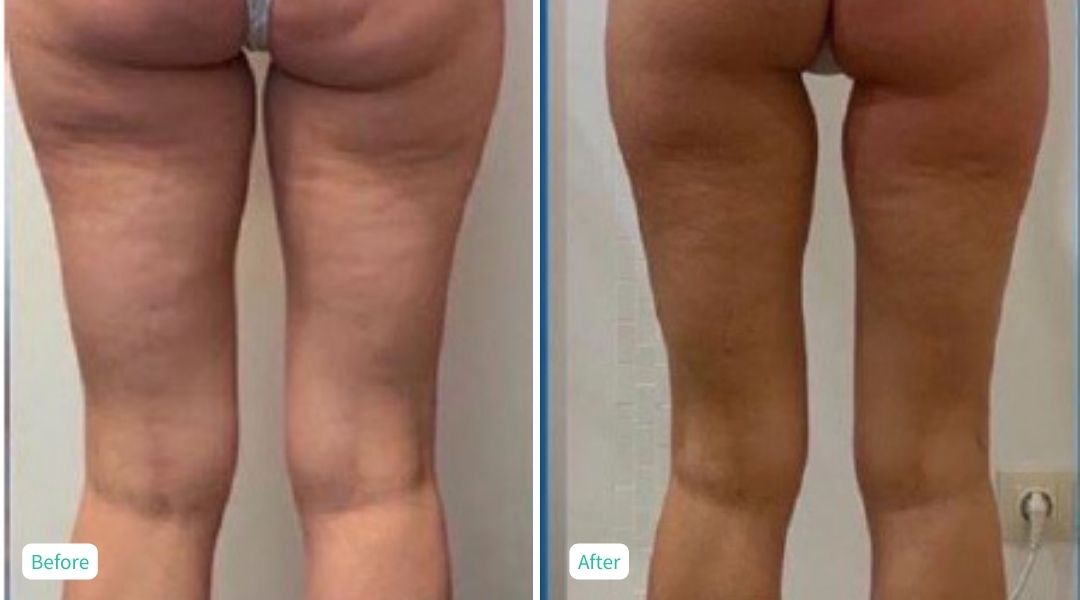 Cellulite Treatment 10 sessions - Case 4