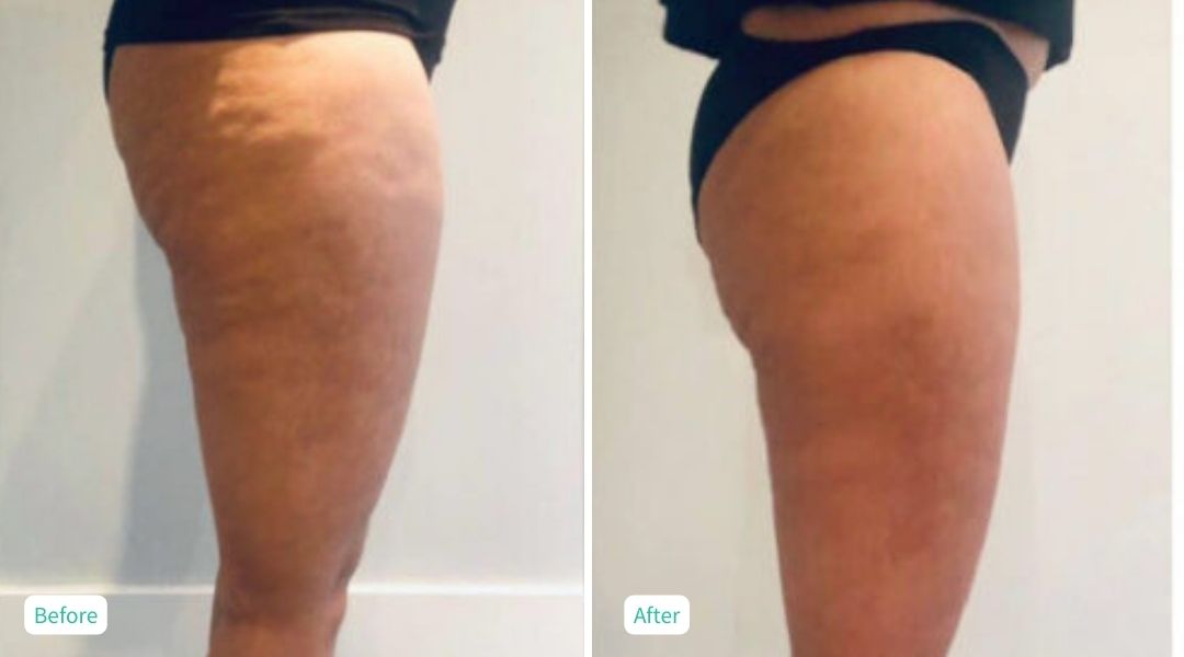 Cellulite Treatment 12 sessions - Case 7
