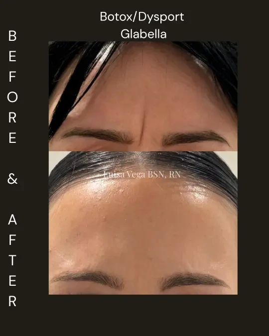 Before and after Botox/Dysport glabella treatment showing reduced frown lines between eyebrows