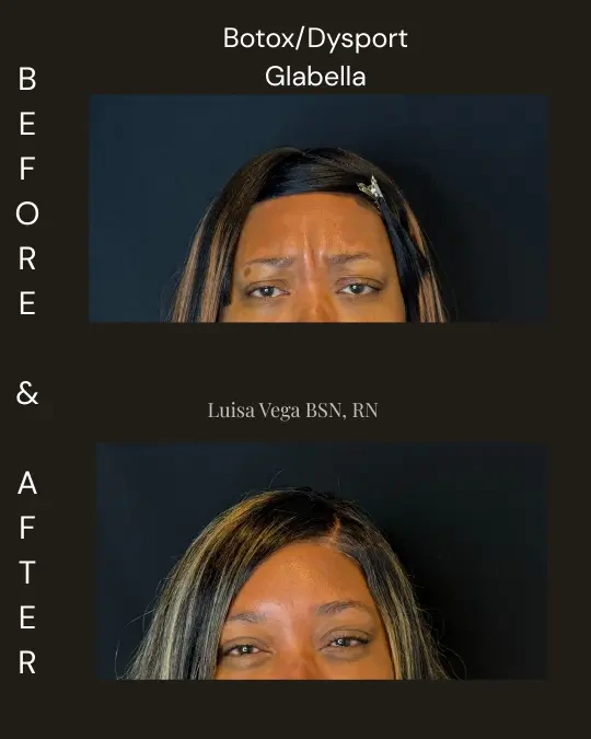Before and after Botox/Dysport treatment to glabella, showing reduced forehead wrinkles