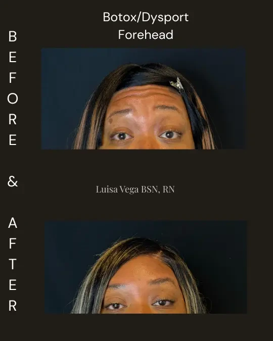 Before and after Botox/Dysport treatment to forehead, showing reduced horizontal lines