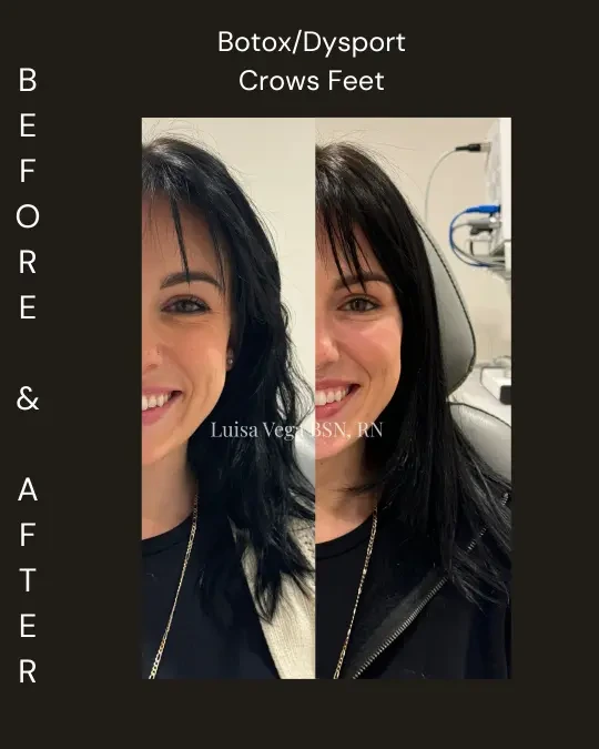 Before and after Botox/Dysport treatment to crow's feet, showing reduced eye wrinkles on smiling