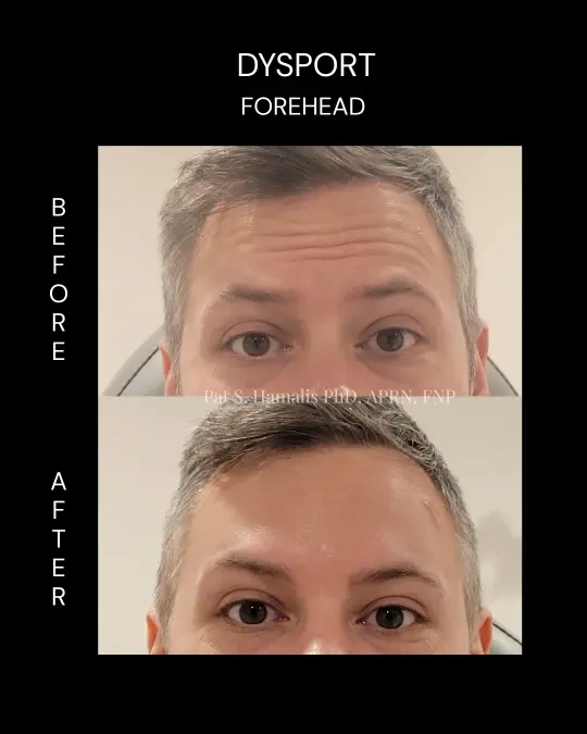 Patient's forehead before and after Dysport treatment showing reduced horizontal lines