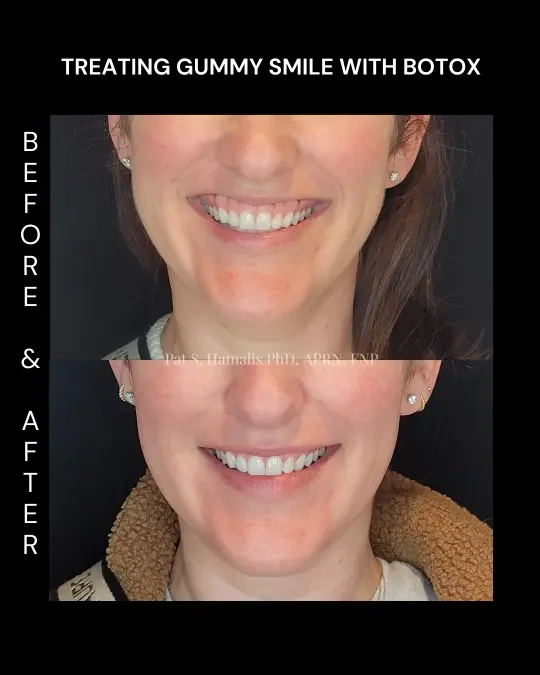 Before and after Botox showing reduced gummy smile with less gum exposure