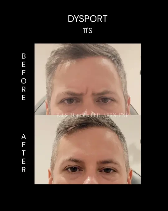 Patient's face before and after Dysport treatment for 11 lines between eyebrows
