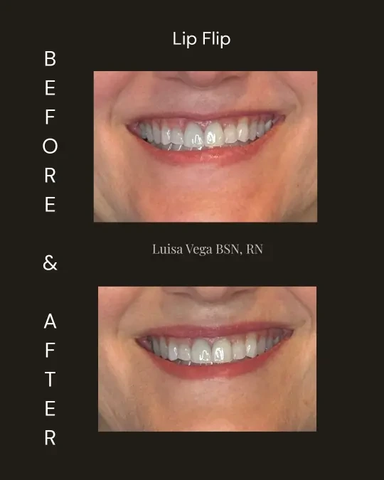 Patient smile showing Lip Flip results with fuller lip appearance, before and after by Luisa Vega BSN, RN