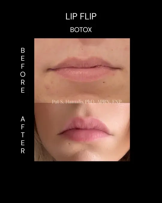 Before and after lip flip with Botox showing fuller, more defined lips