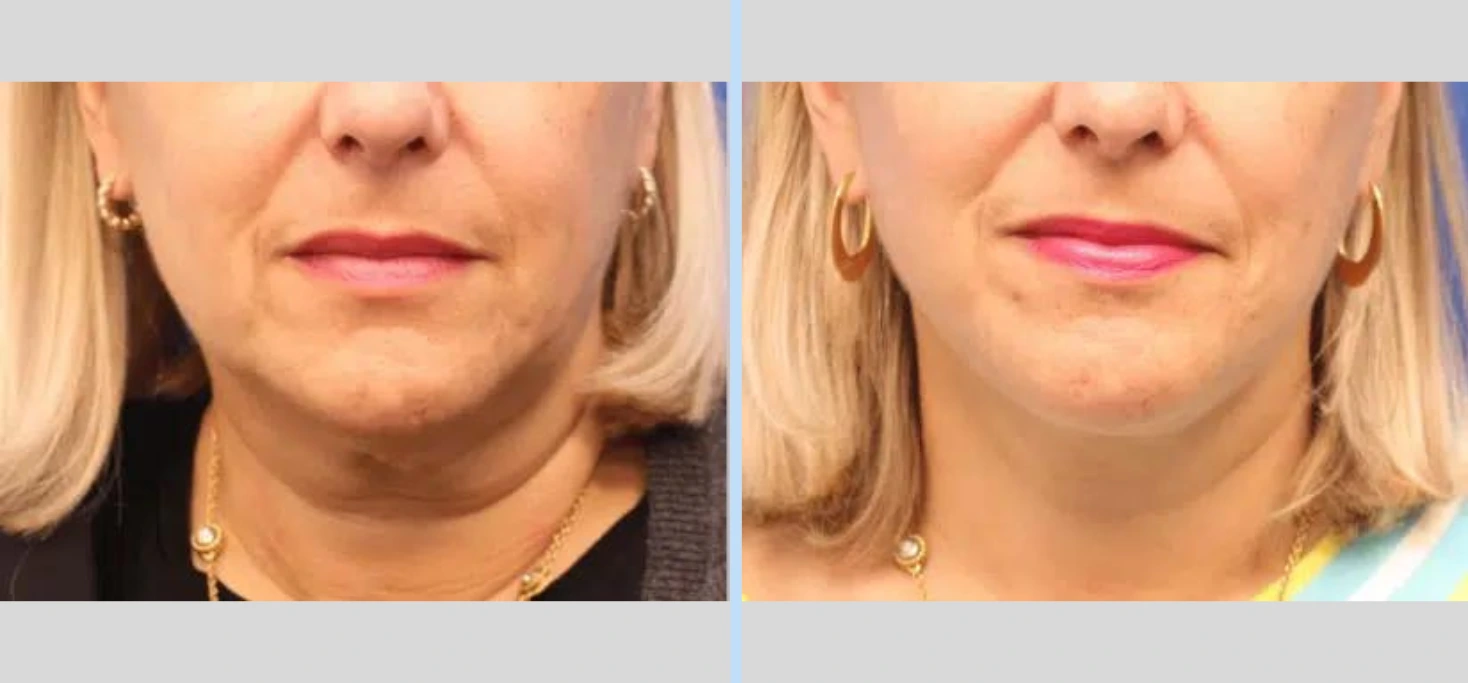 Before and After Gallery: Neck Lift A Banner