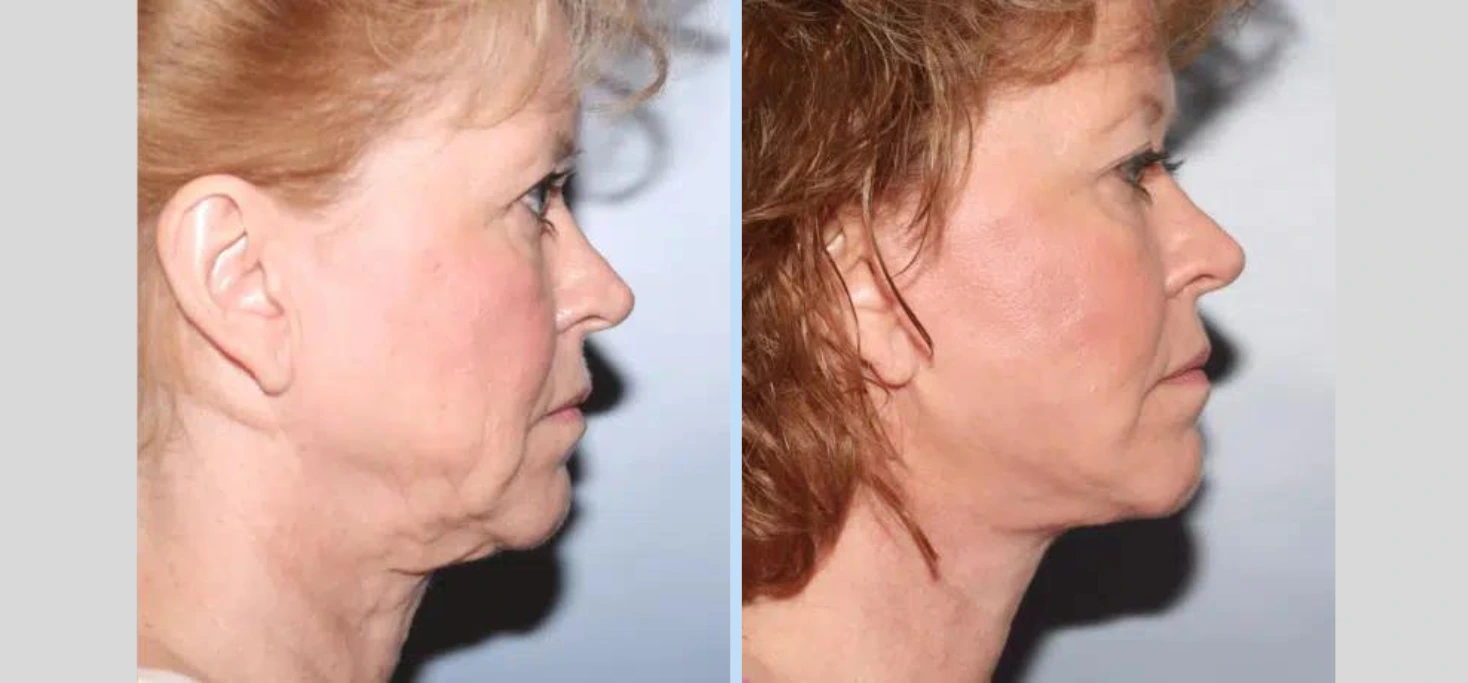 Before and After Gallery: Neck Lift B Banner