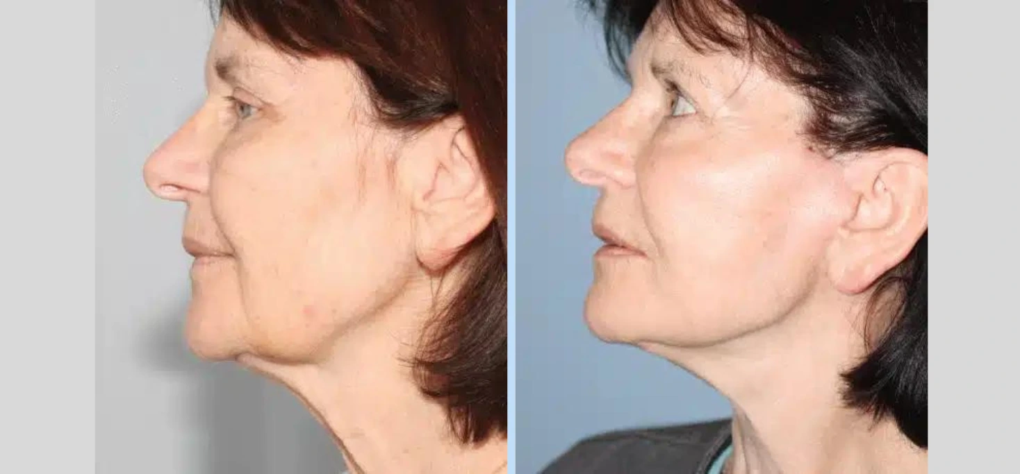 Before and After Gallery: Neck Lift C Banner
