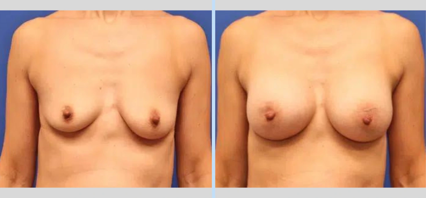 Breast Augmentation Before & After - Case 11 Banner