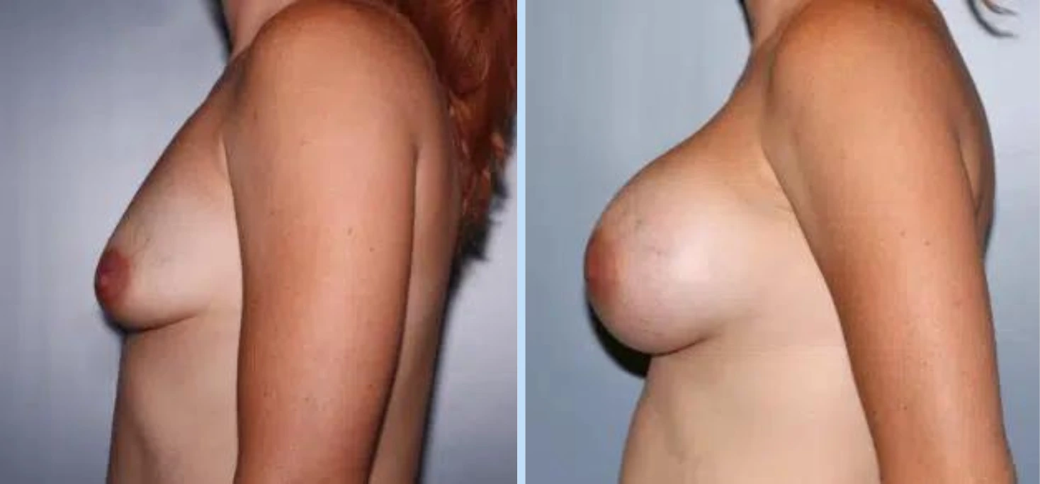 Breast Augmentation Before & After - Case 14 Banner