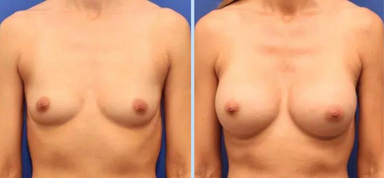 Breast Augmentation Before & After - Case 17 Banner
