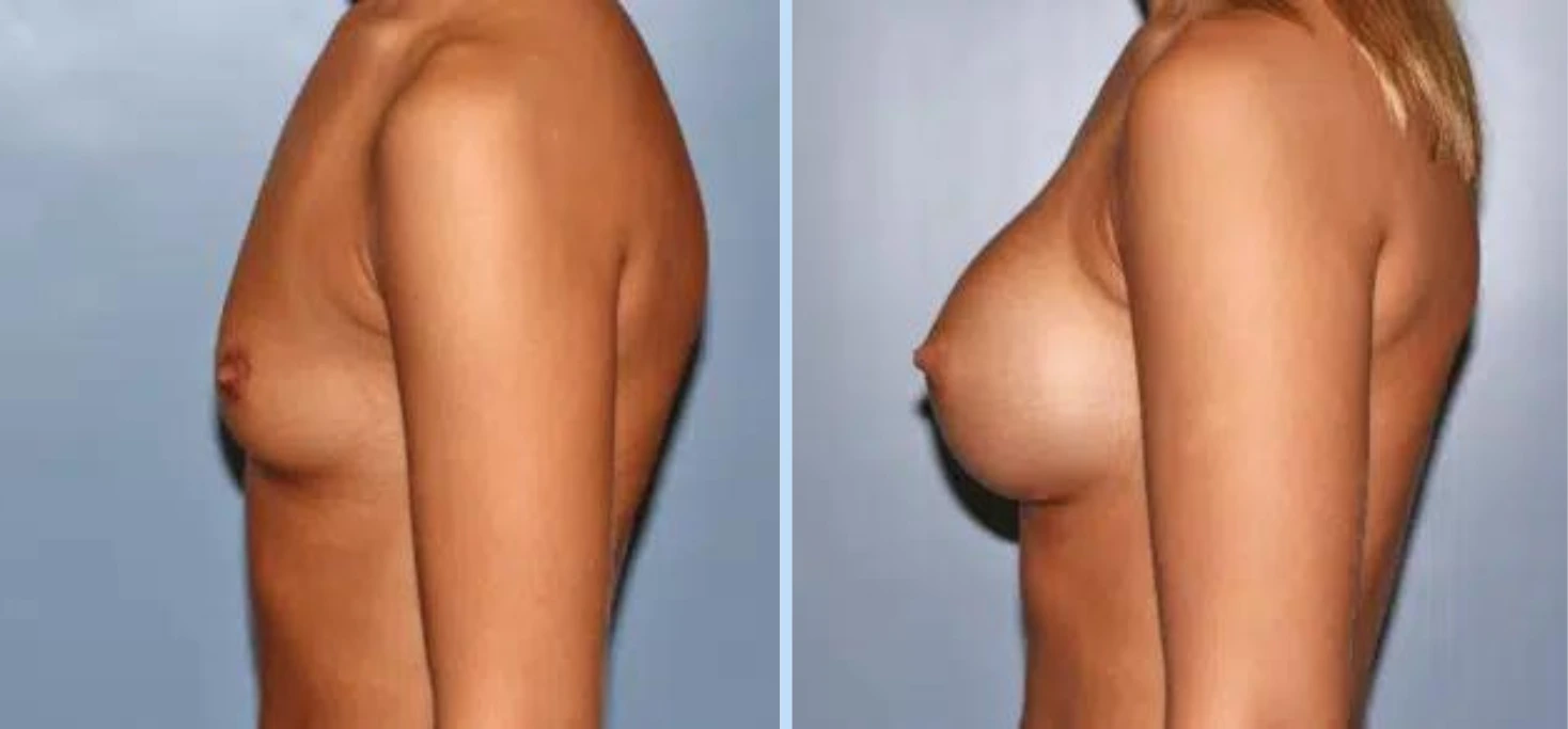 Breast Augmentation Before & After - Case 23
