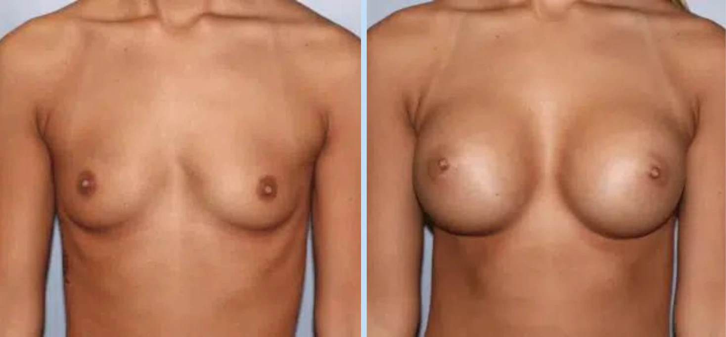 Breast Augmentation Before & After - Case 23
