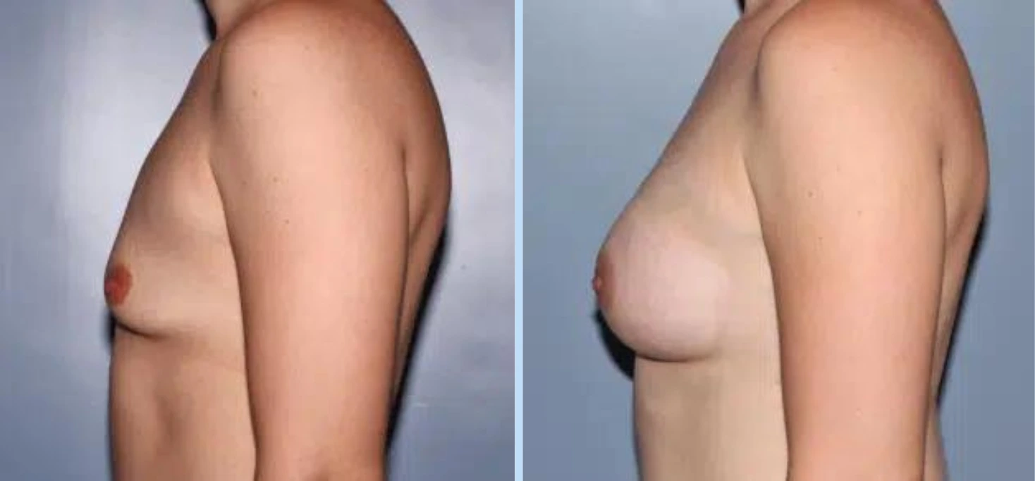 Breast Augmentation Before & After - Case 28
