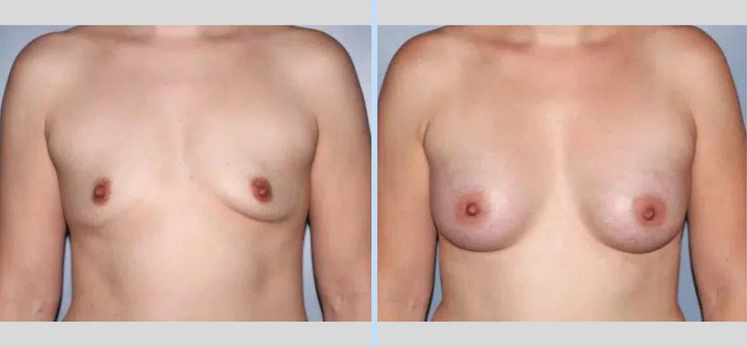Breast Augmentation Before & After - Case 28