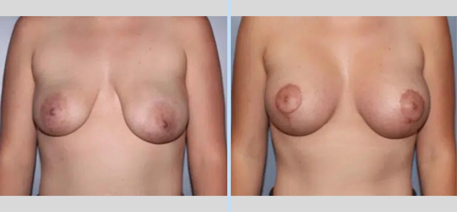 Breast Lift Before & After - Case 4