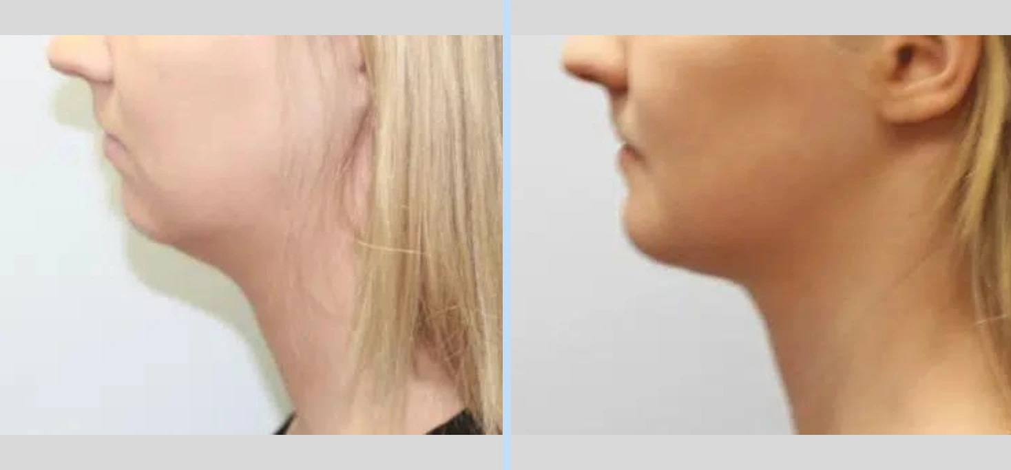 Chin Augmentation Before & After - Case 2