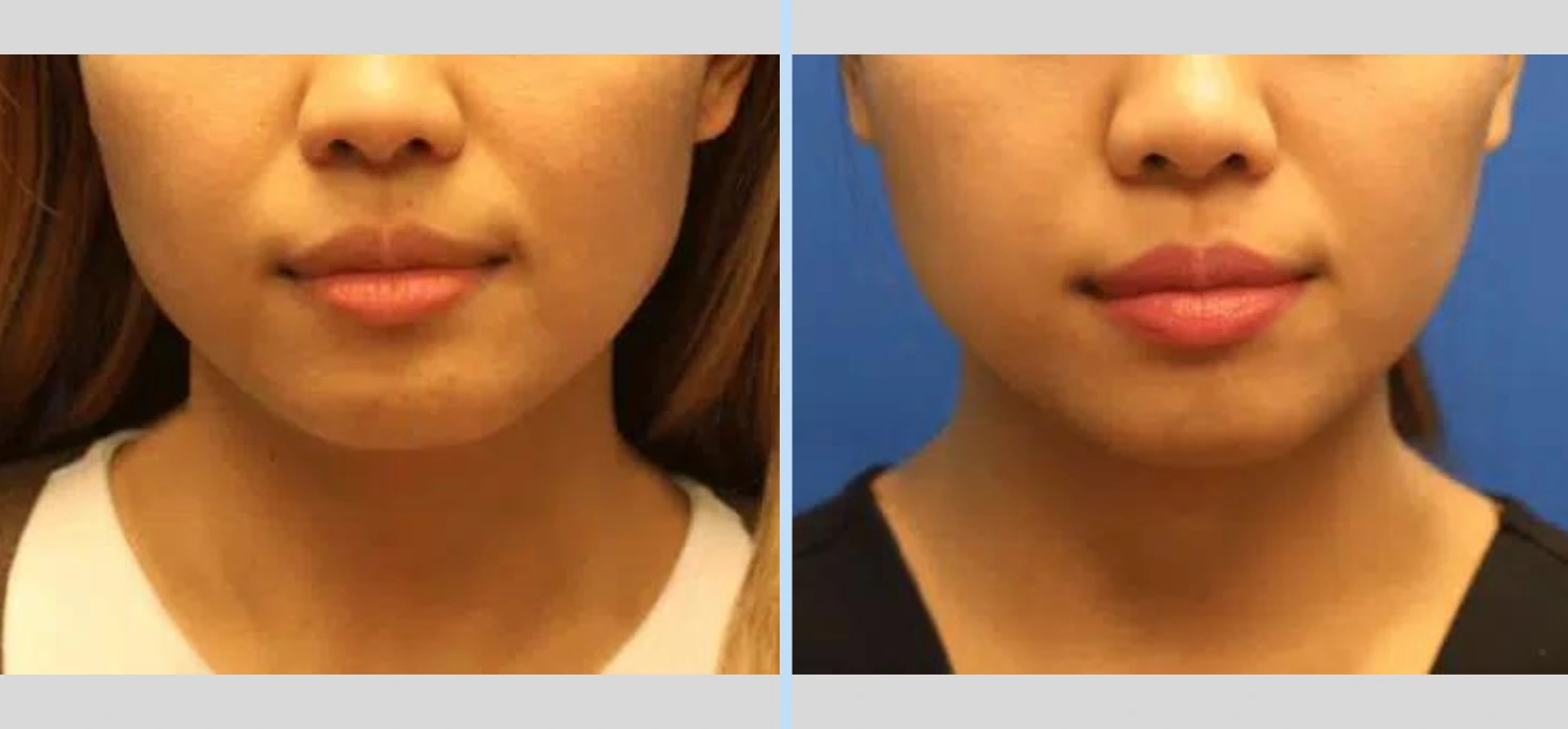 Chin Augmentation Before & After - Case 4