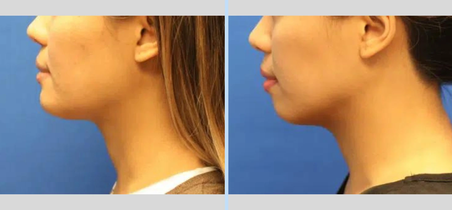 Chin Augmentation Before & After - Case 4
