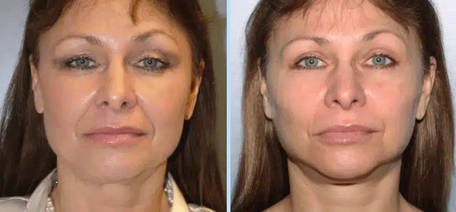 Facelift Before & After - Case 6