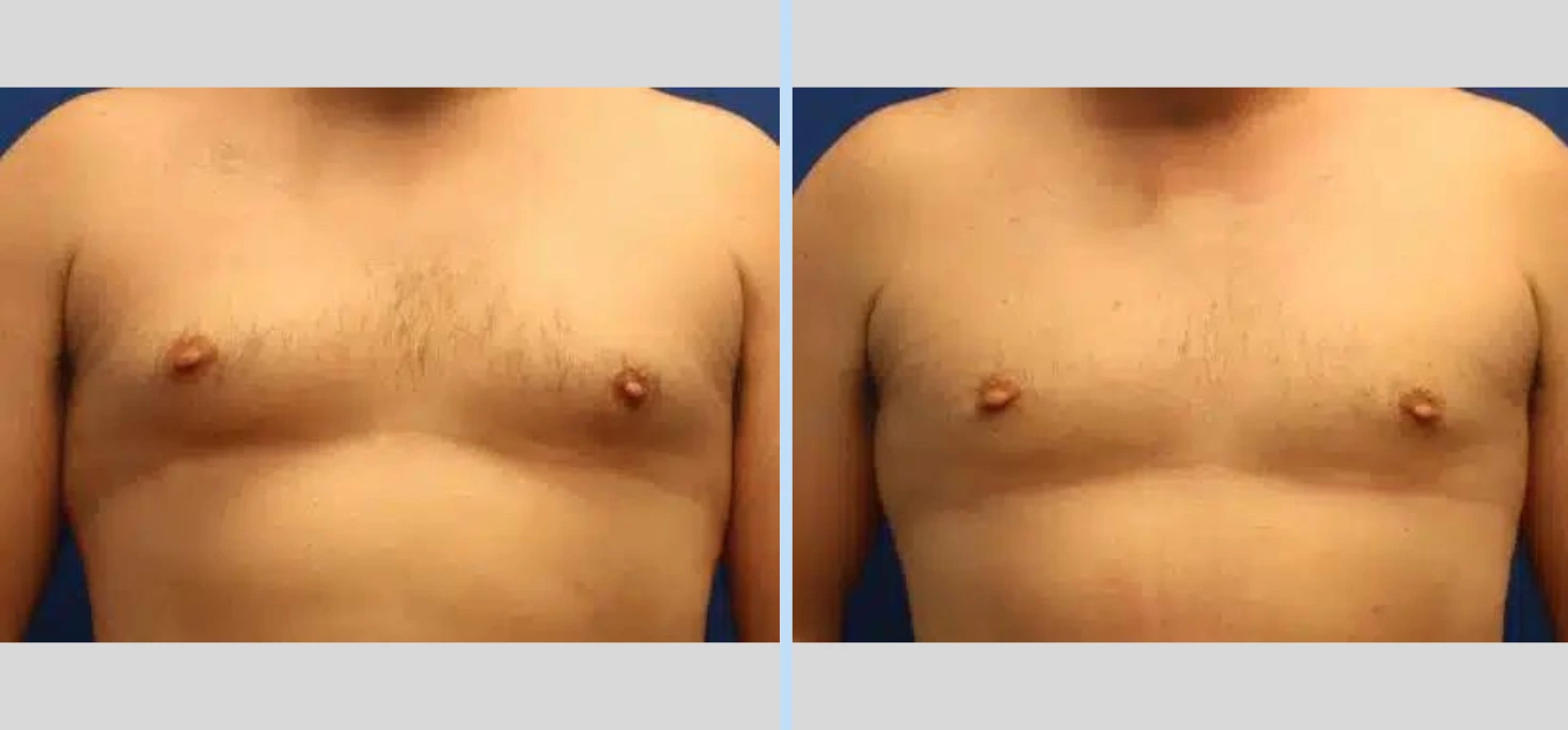 Gynecomastia Before & After - Case 1