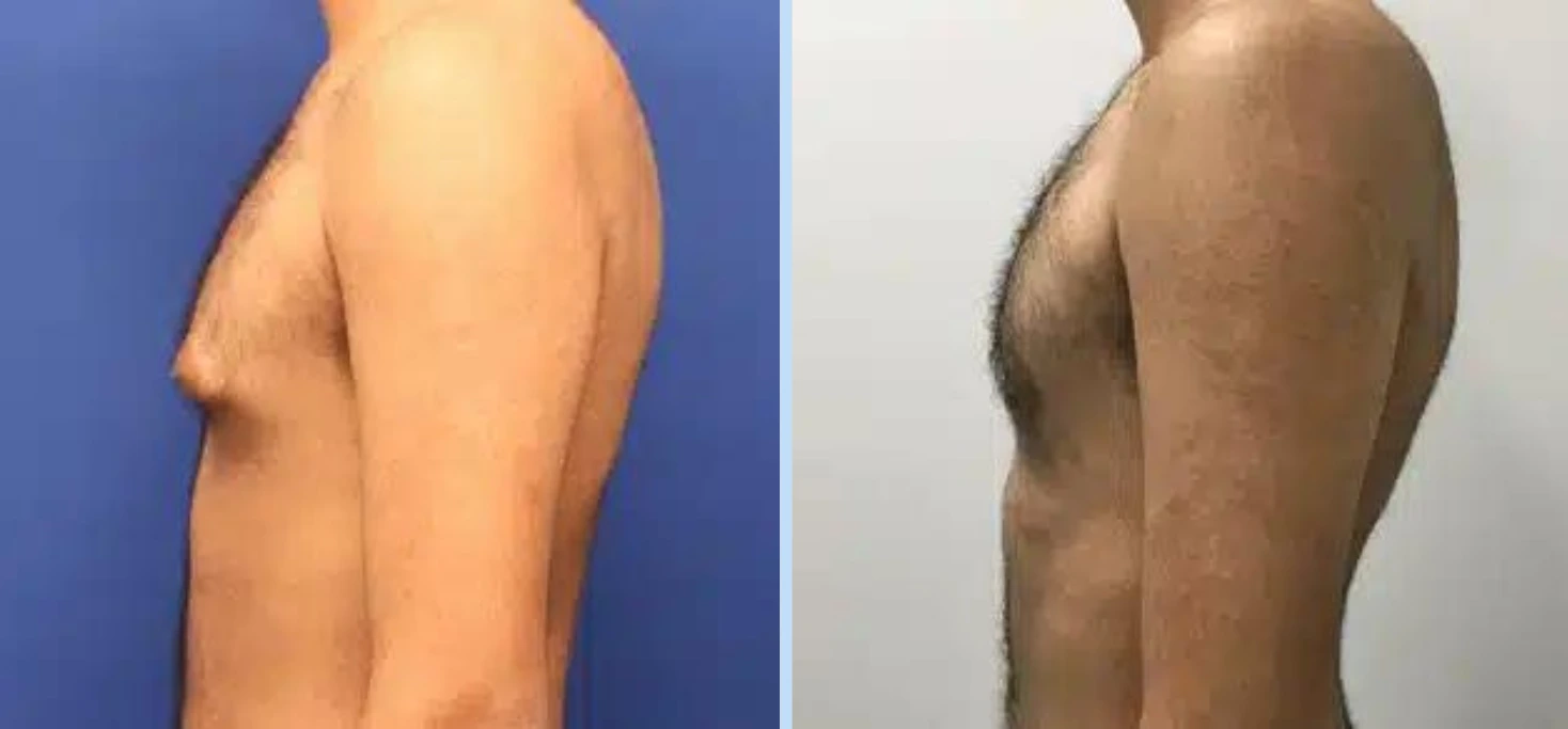 Gynecomastia Before & After - Case 2