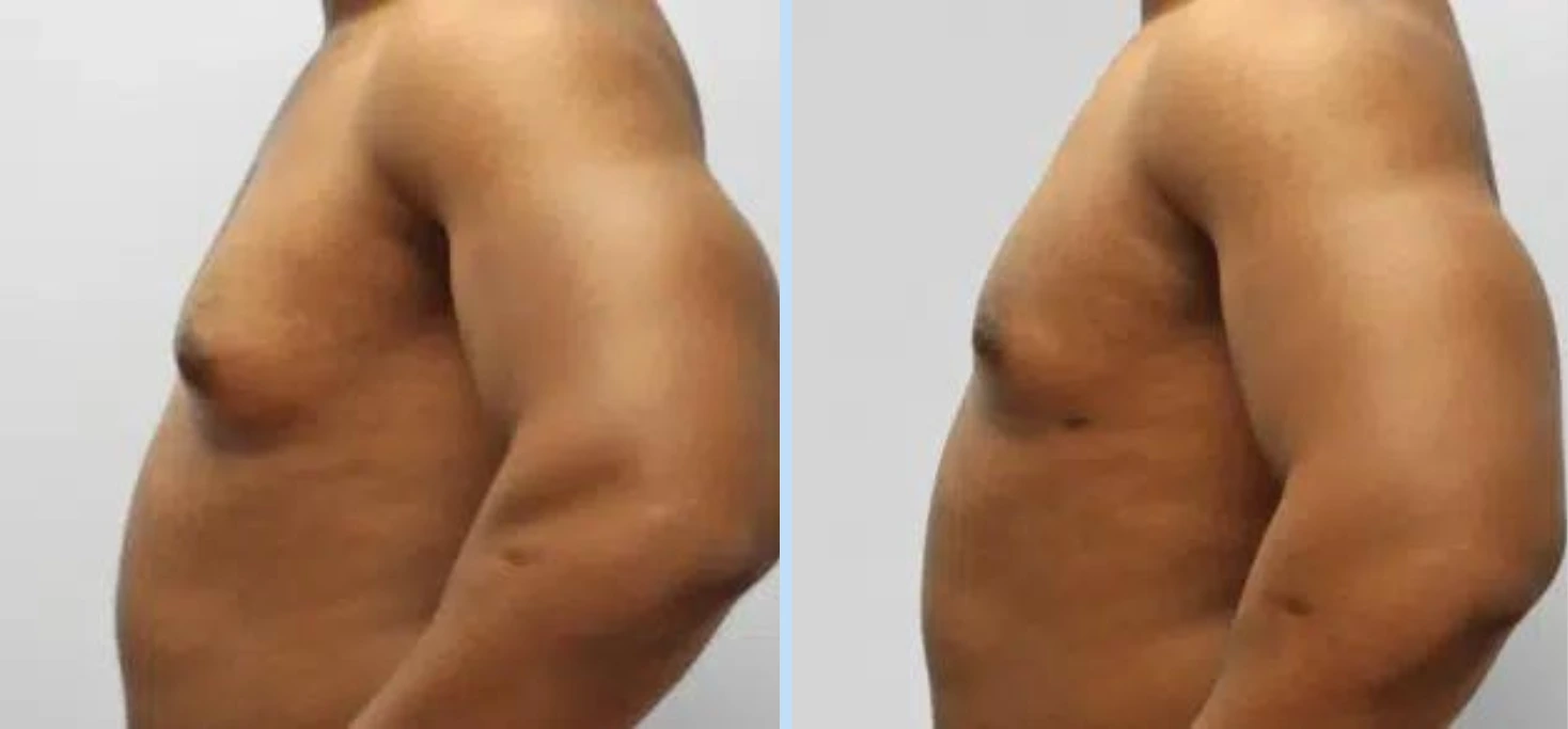 Gynecomastia Before & After - Case 3