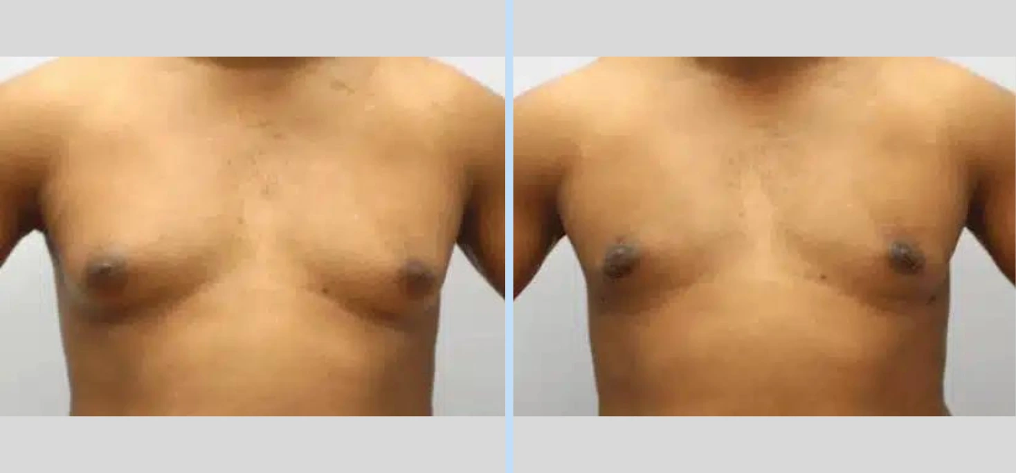 Gynecomastia Before & After - Case 3