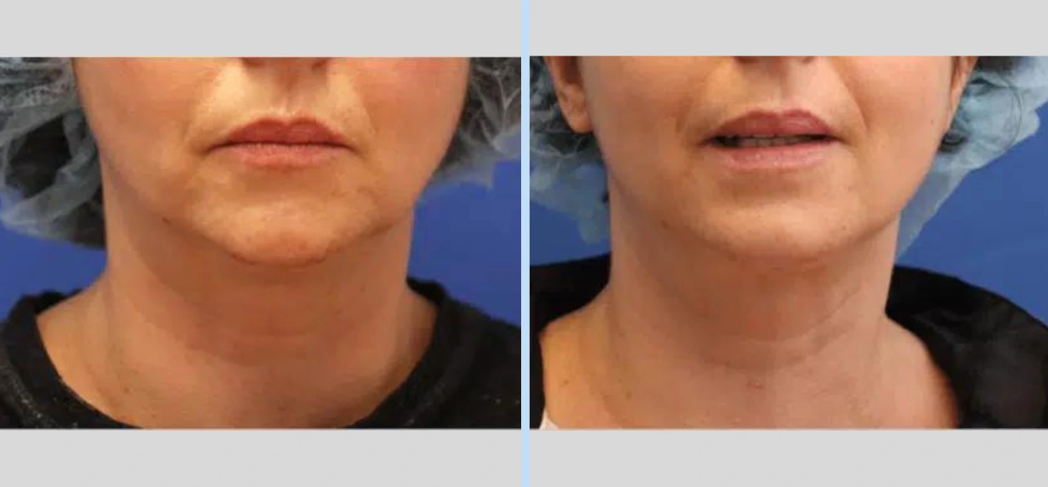 Laser Neck Lift Before & After - Case 3