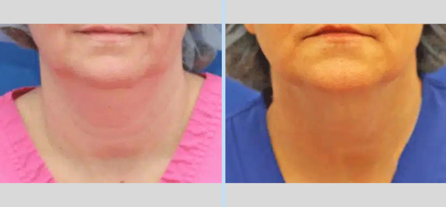 Laser Neck Lift Before & After - Case 4