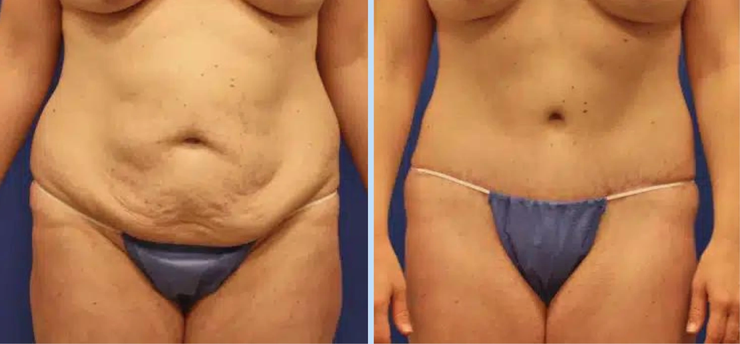 Mommy Makeover Before & After Photos - Case 1 Banner