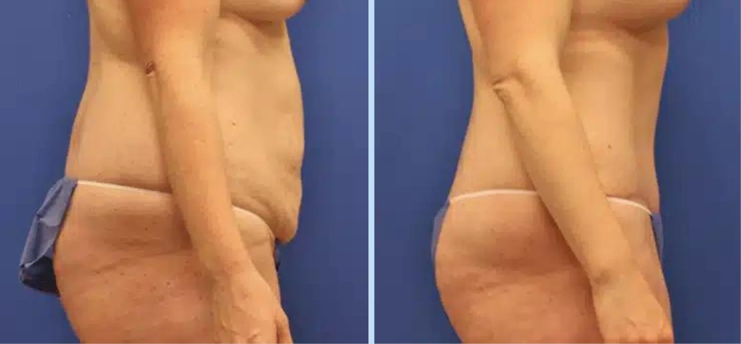 Mommy Makeover Before & After Photos - Case 1 Banner