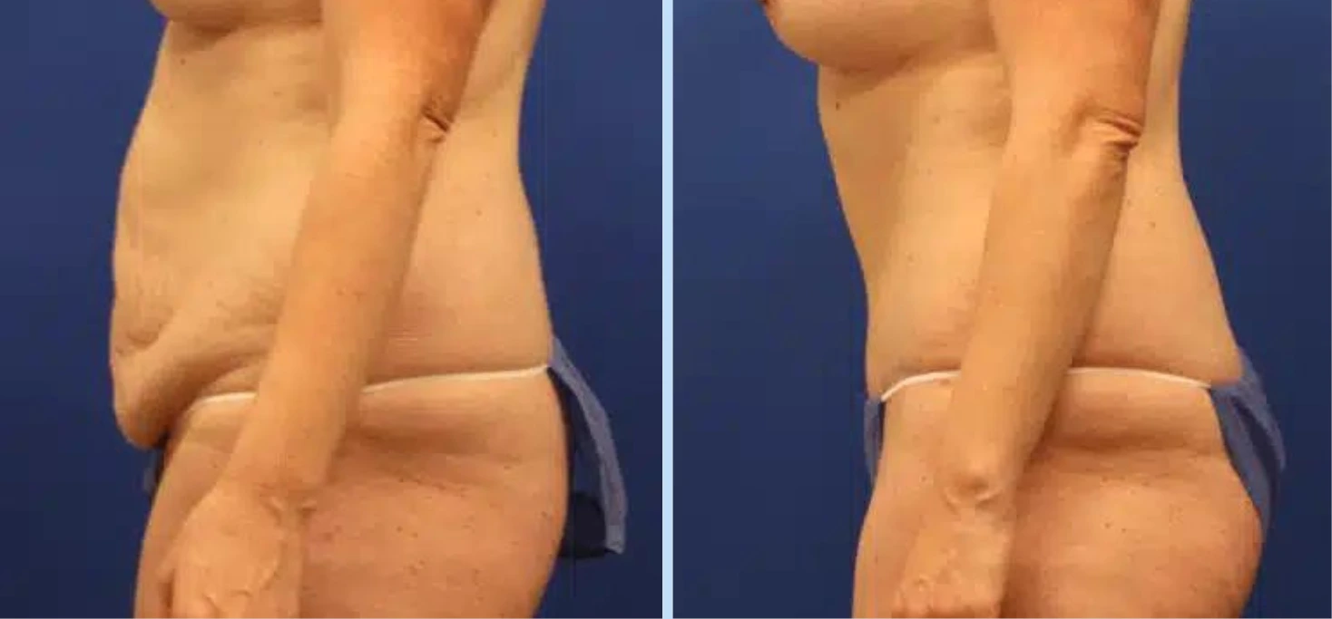 Mommy Makeover Before & After Photos - Case 1 Banner