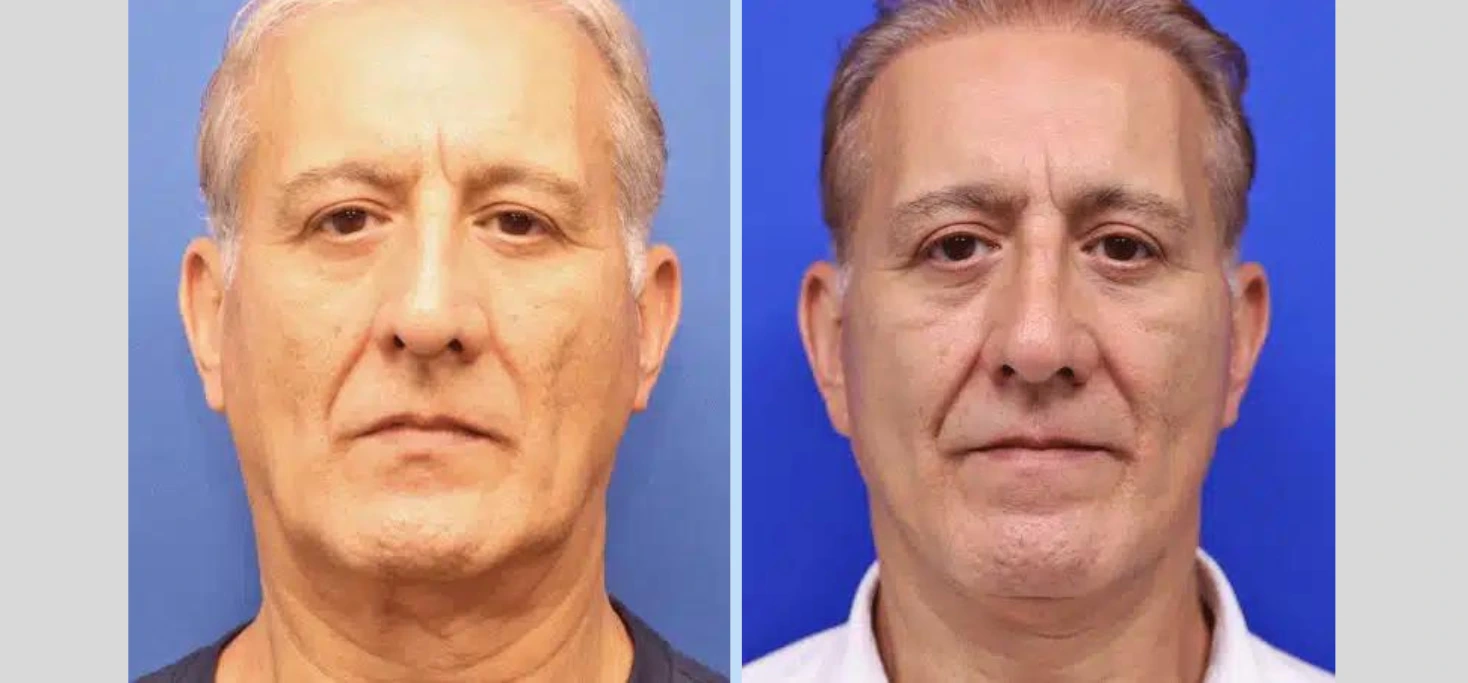 Neck Lift Before & After - Case 3