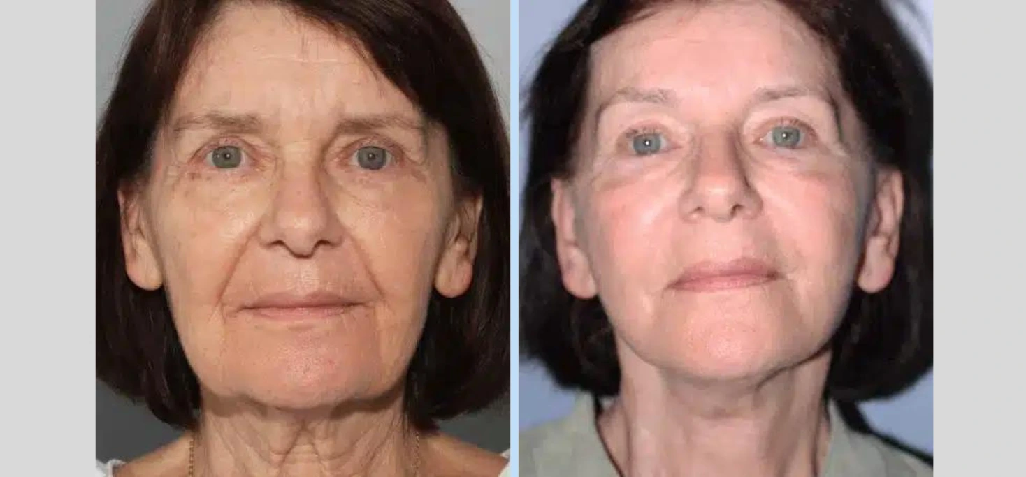 Neck Lift Before & After - Case 4