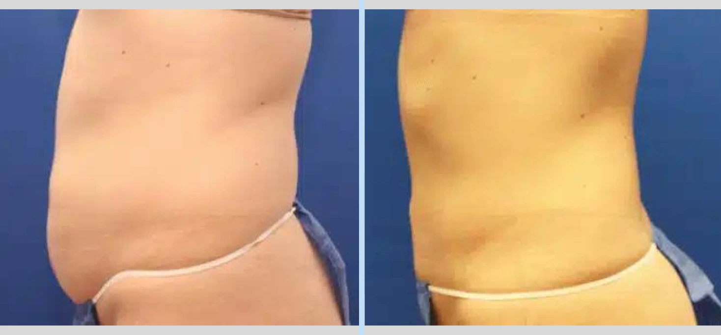 SmartLipo Before & After - Case 3 Banner