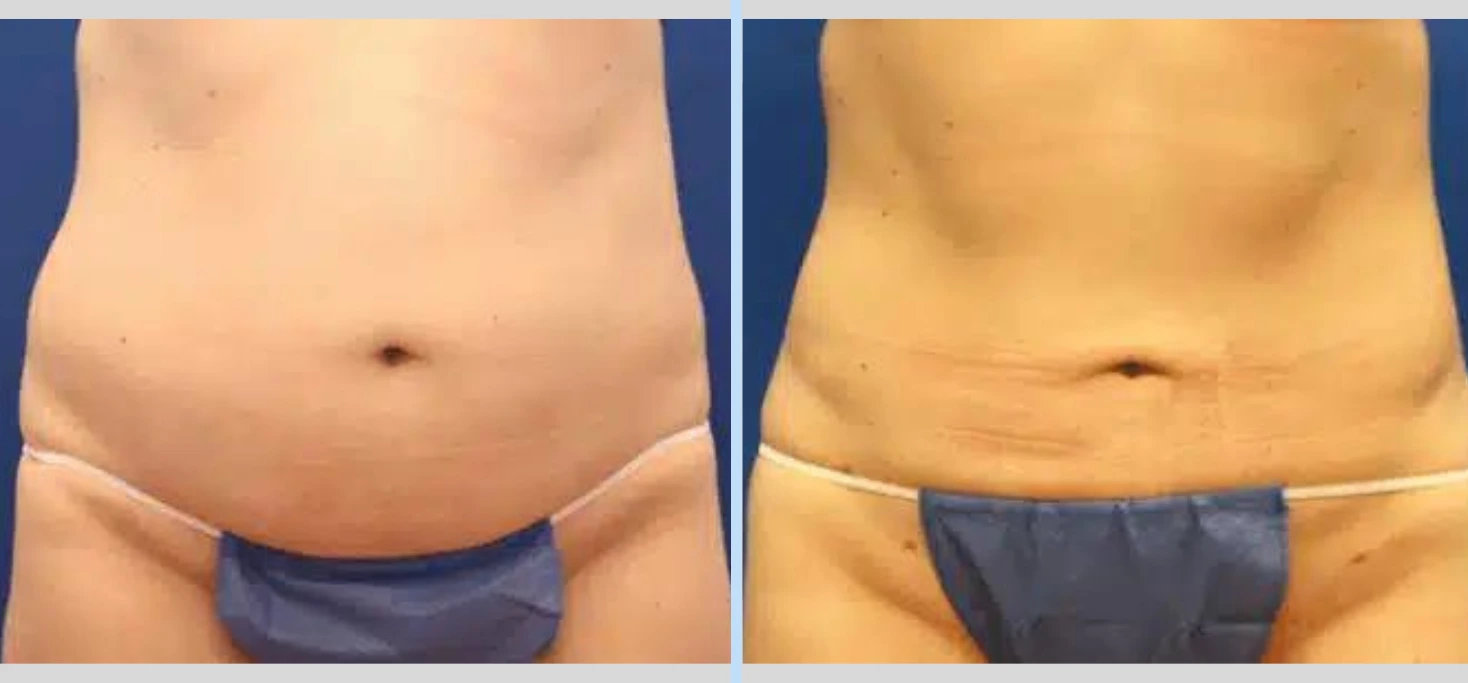 SmartLipo Before & After - Case 3 Banner