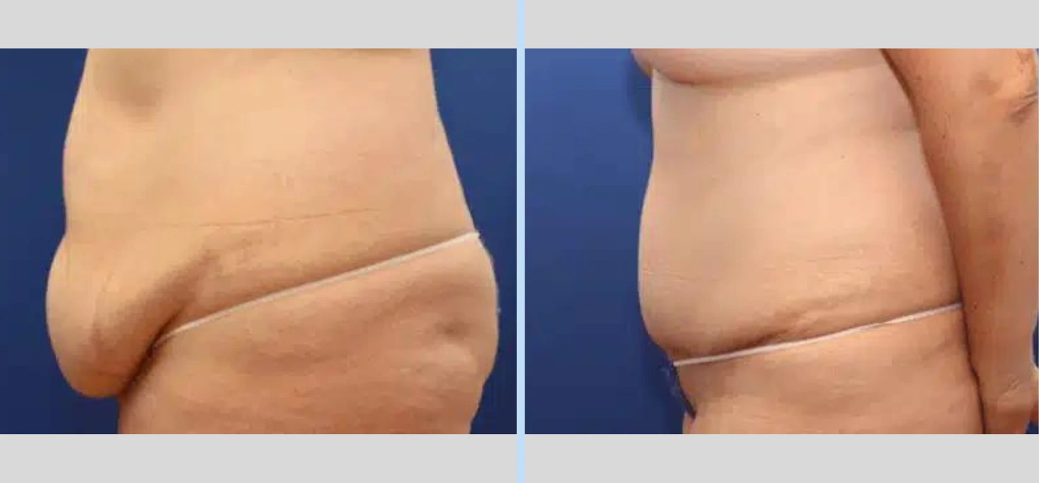Tummy Tuck Before & After – Case 10 Banner