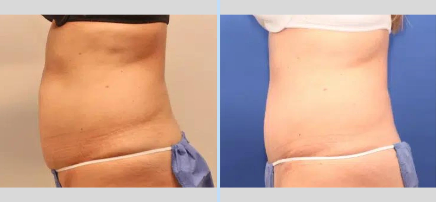 Tummy Tuck Before & After – Case 11 Banner