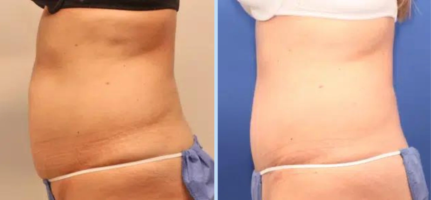 Tummy Tuck Before & After – Case 6 Banner
