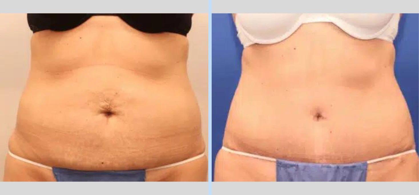 Tummy Tuck Before & After – Case 6 Banner
