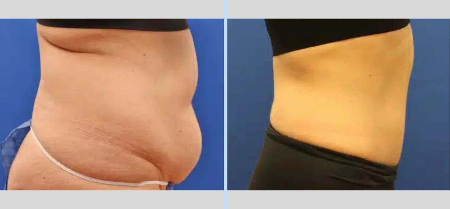 Tummy Tuck Before & After – Case 8 Banner