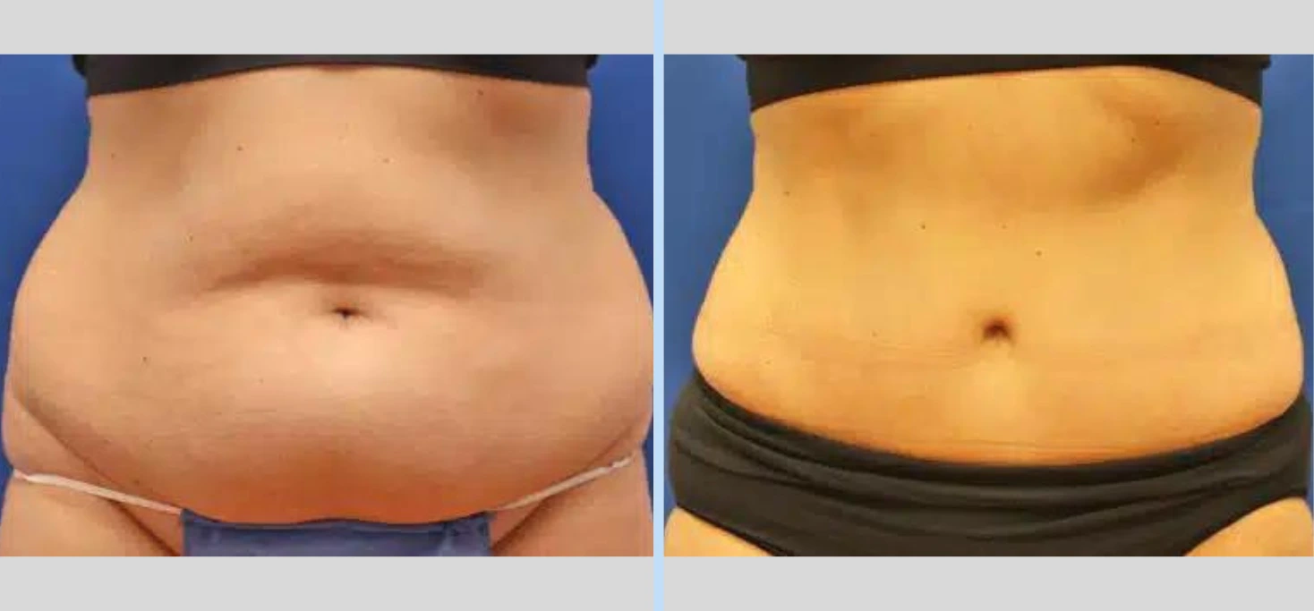 Tummy Tuck Before & After – Case 8 Banner