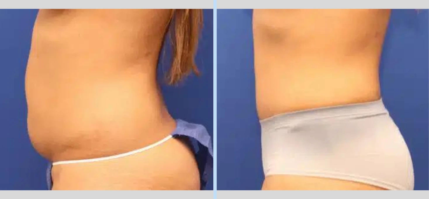 Tummy Tuck Before & After – Case 9 Banner