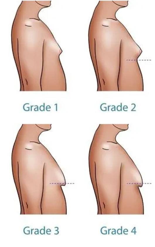 Medical diagram showing four grades of gynecomastia progression from minimal to severe tissue