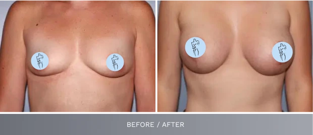 Before and after breast augmentation results showing increased volume and lift