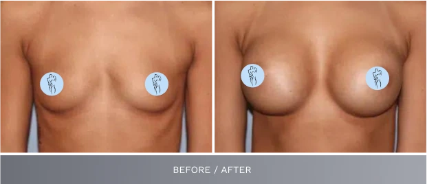 Before and after breast augmentation results showing enhanced fullness and projection
